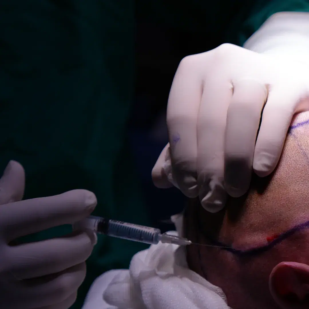 Stem Cell Hair Therapy