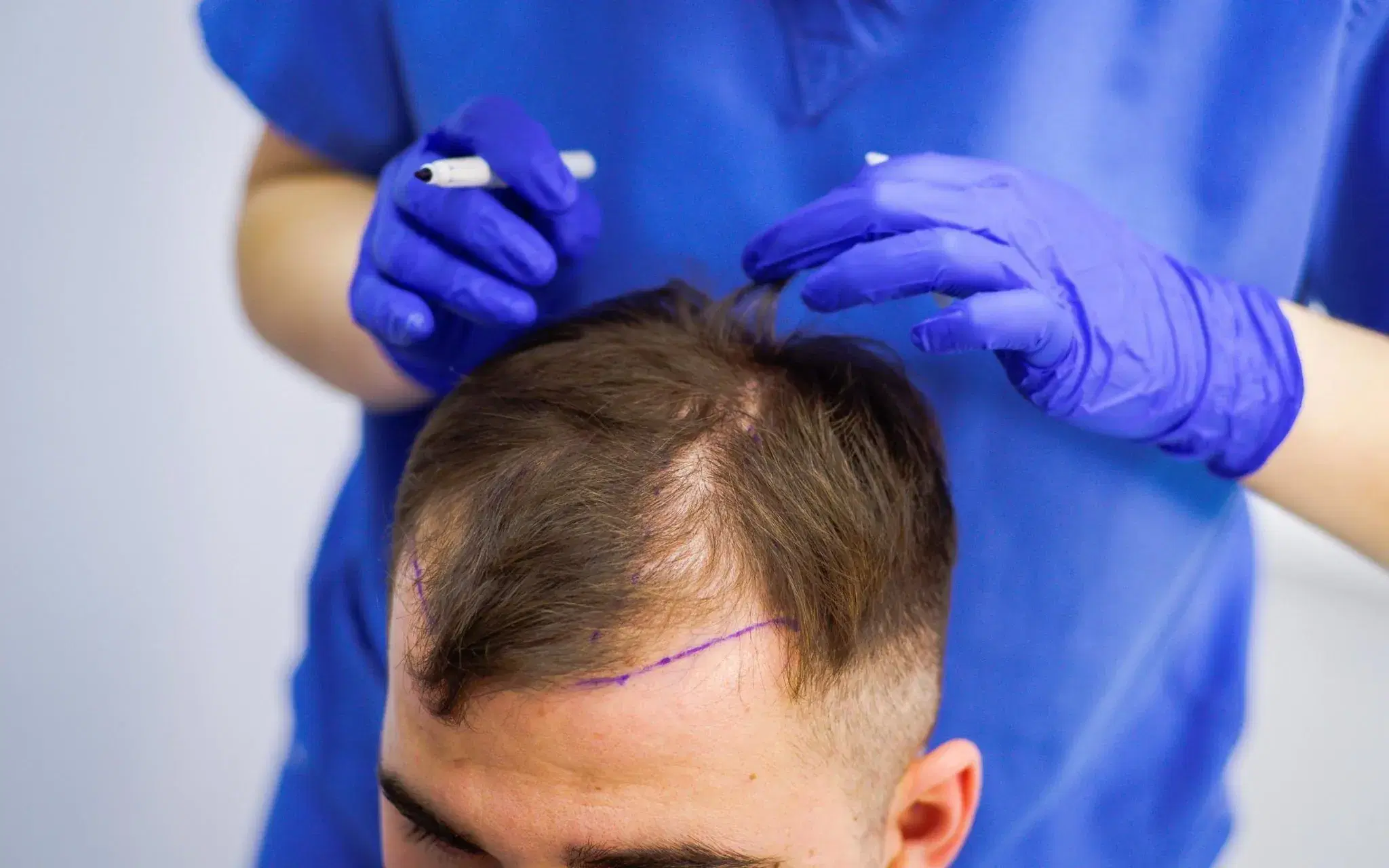 Are 3000 Grafts Enough for a Hair Transplant?