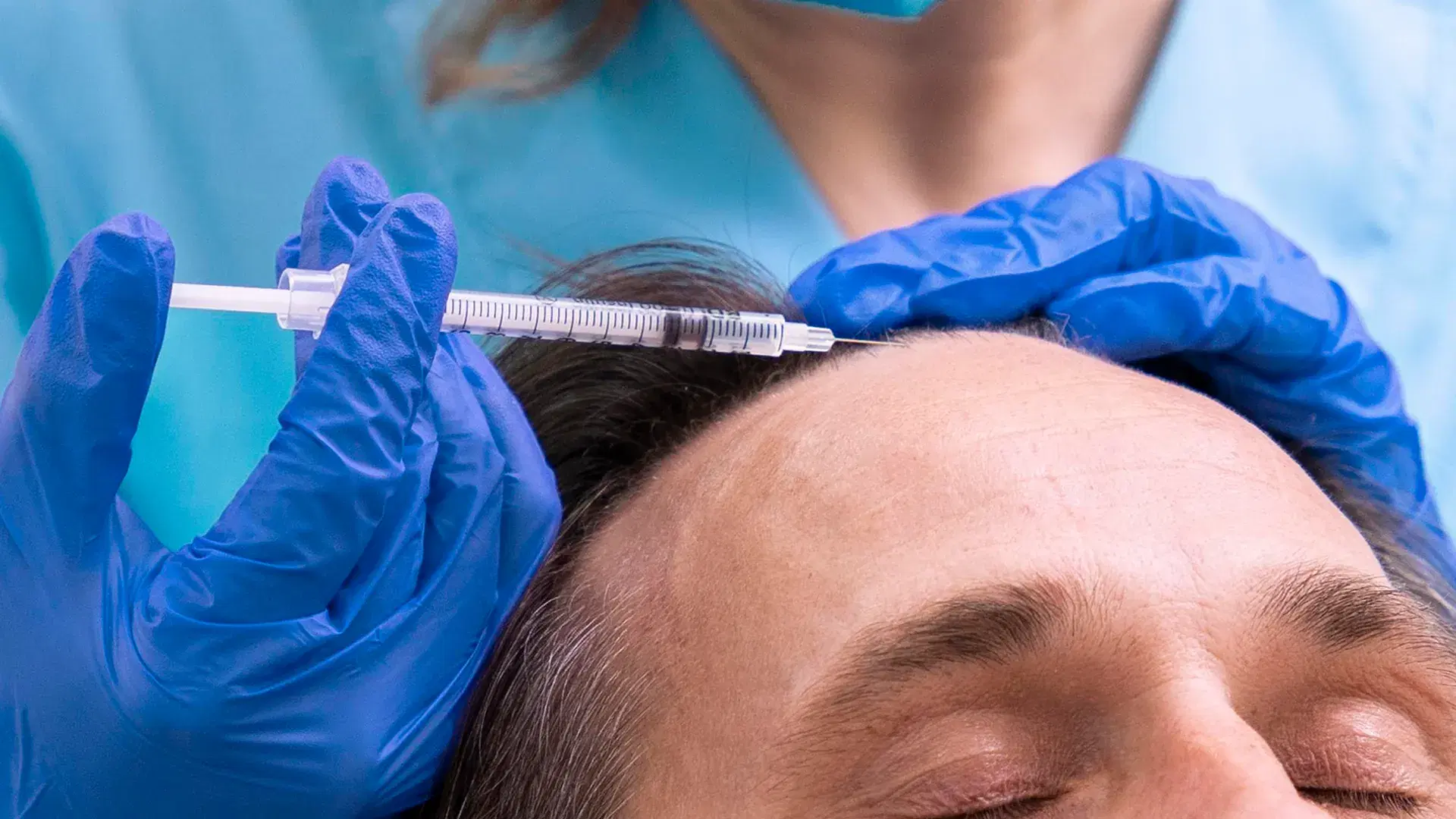 How Mesotherapy for Hair Works on the Scalp?