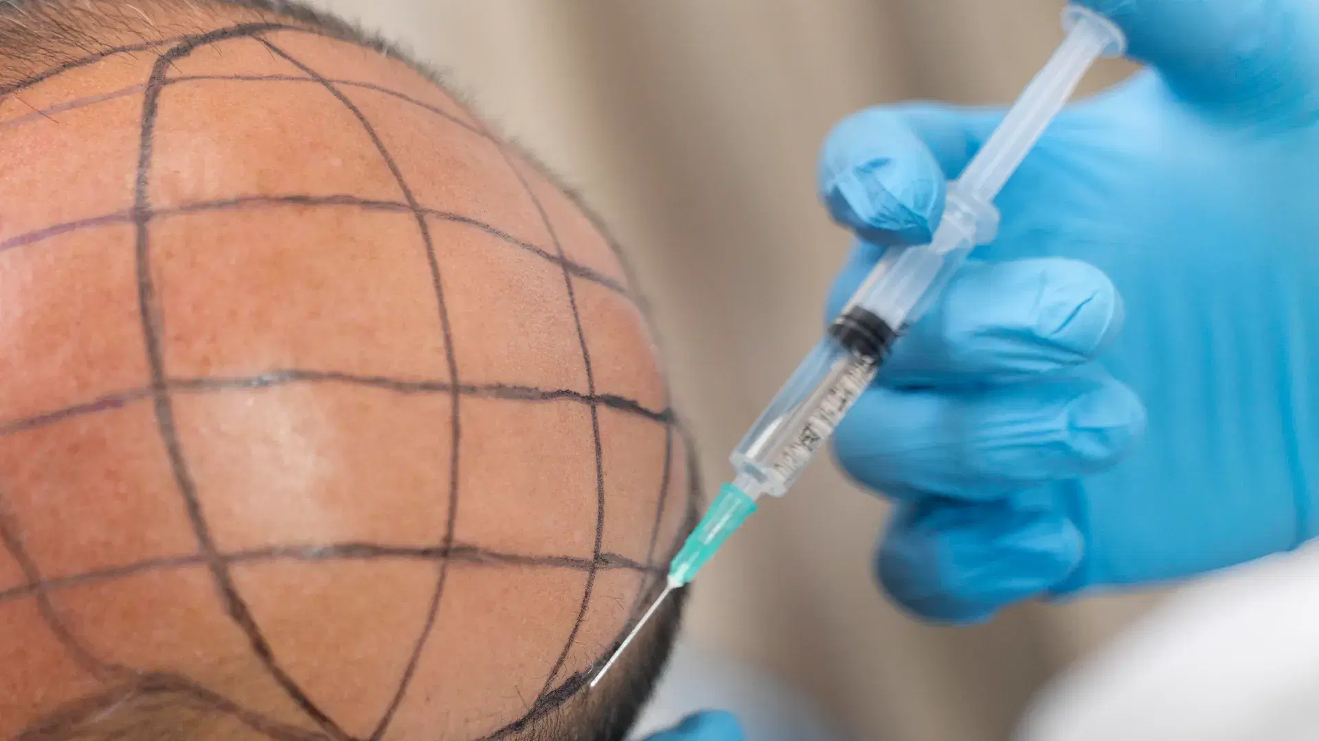 Benefits of Stem Cell Treatment for Hair