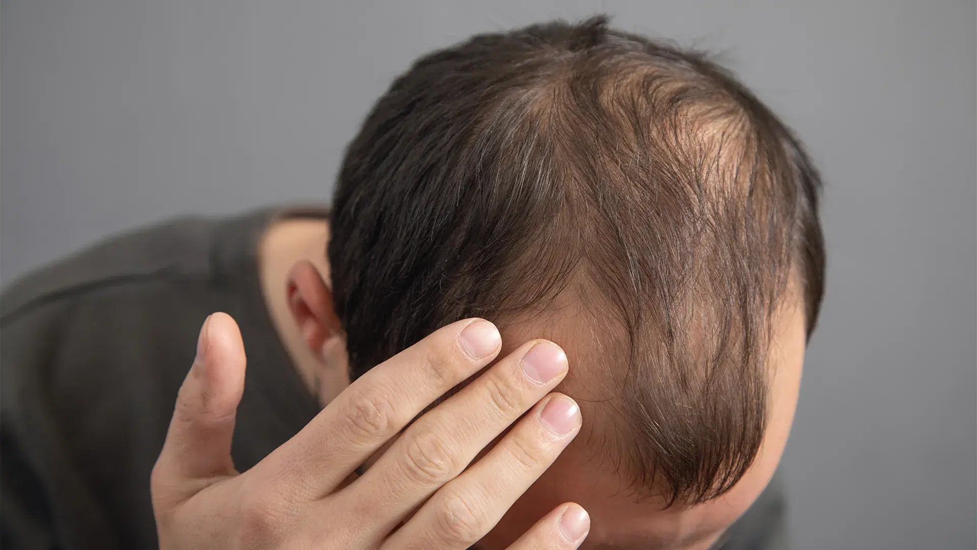 Causes of Pattern Baldness