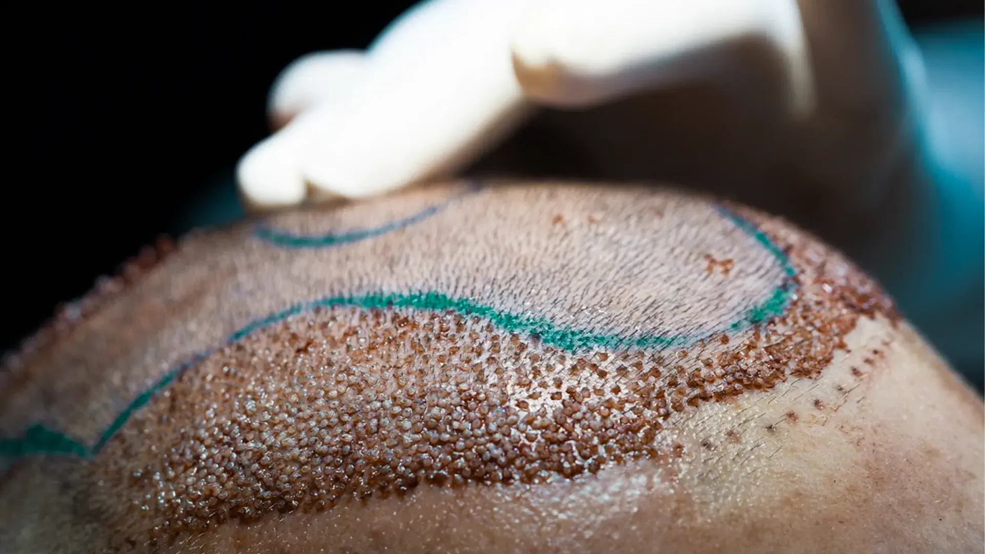 Common Hair Follicle Problems