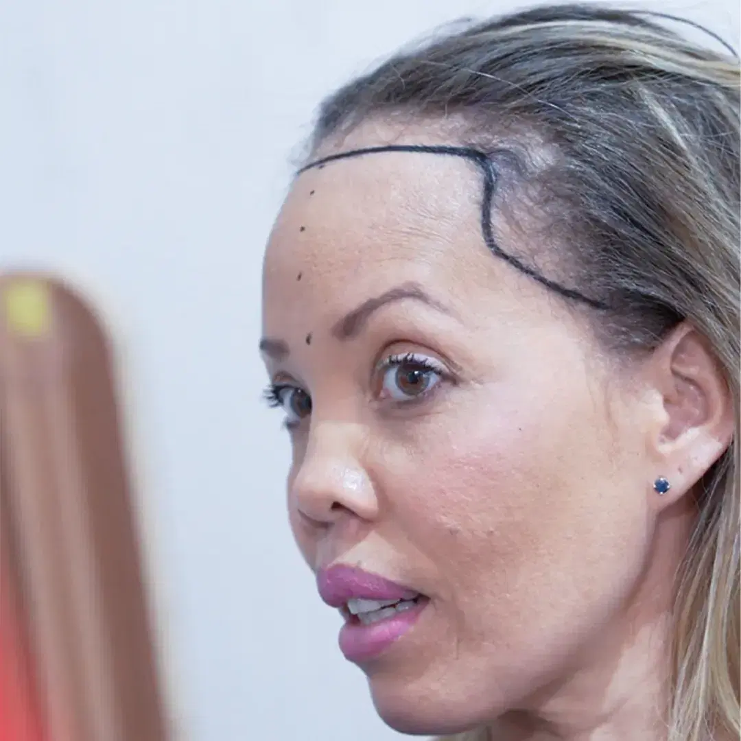 <h3><span style="color: rgb(247, 248, 248);">Donor Hair Extraction</span></h3>