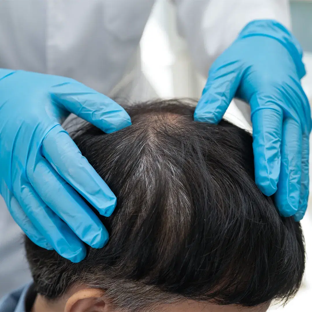 Hair Plugs: The First Step in Surgical Hair Restoration
