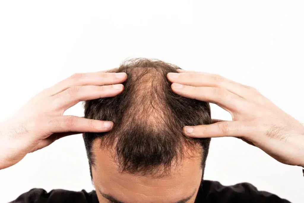 How Much of Transplanted Hair Survives?