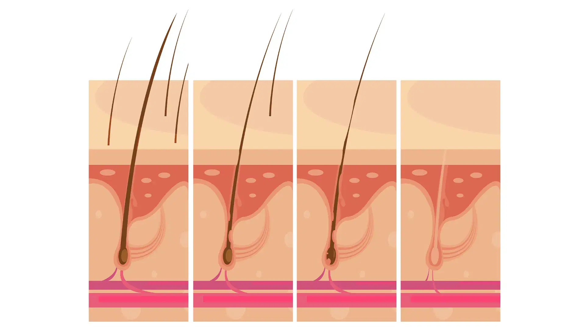 How DHT Affects Hair Follicles?