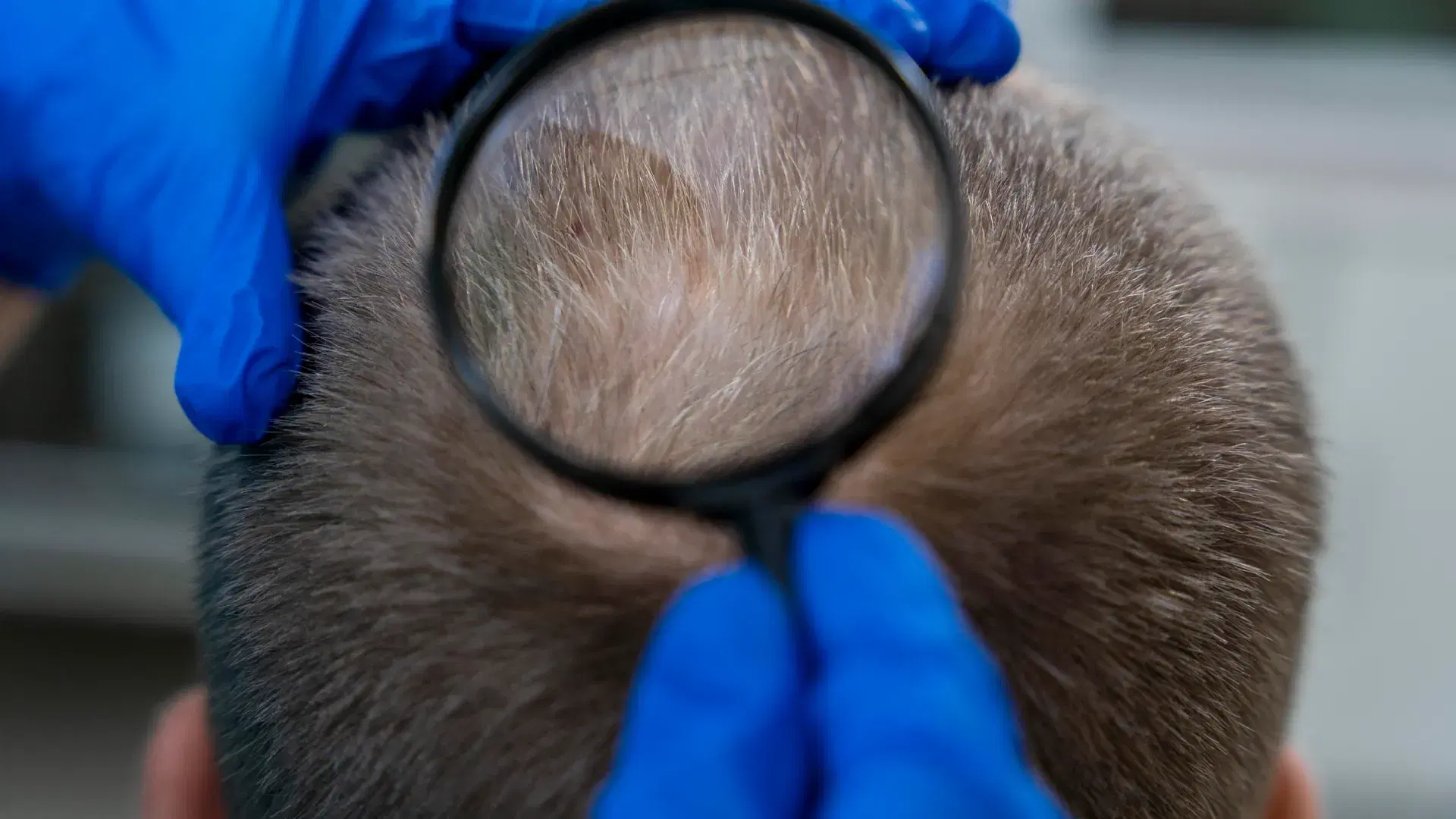 How Diabetes Leads to Hair Loss