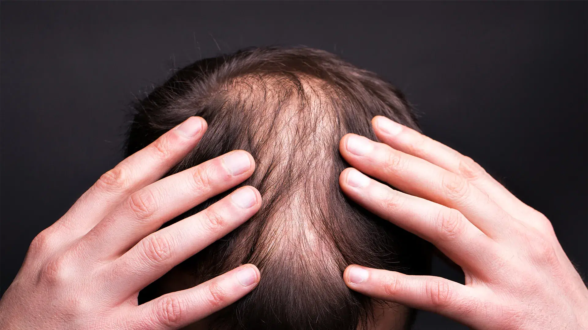 How Pattern Baldness Progresses