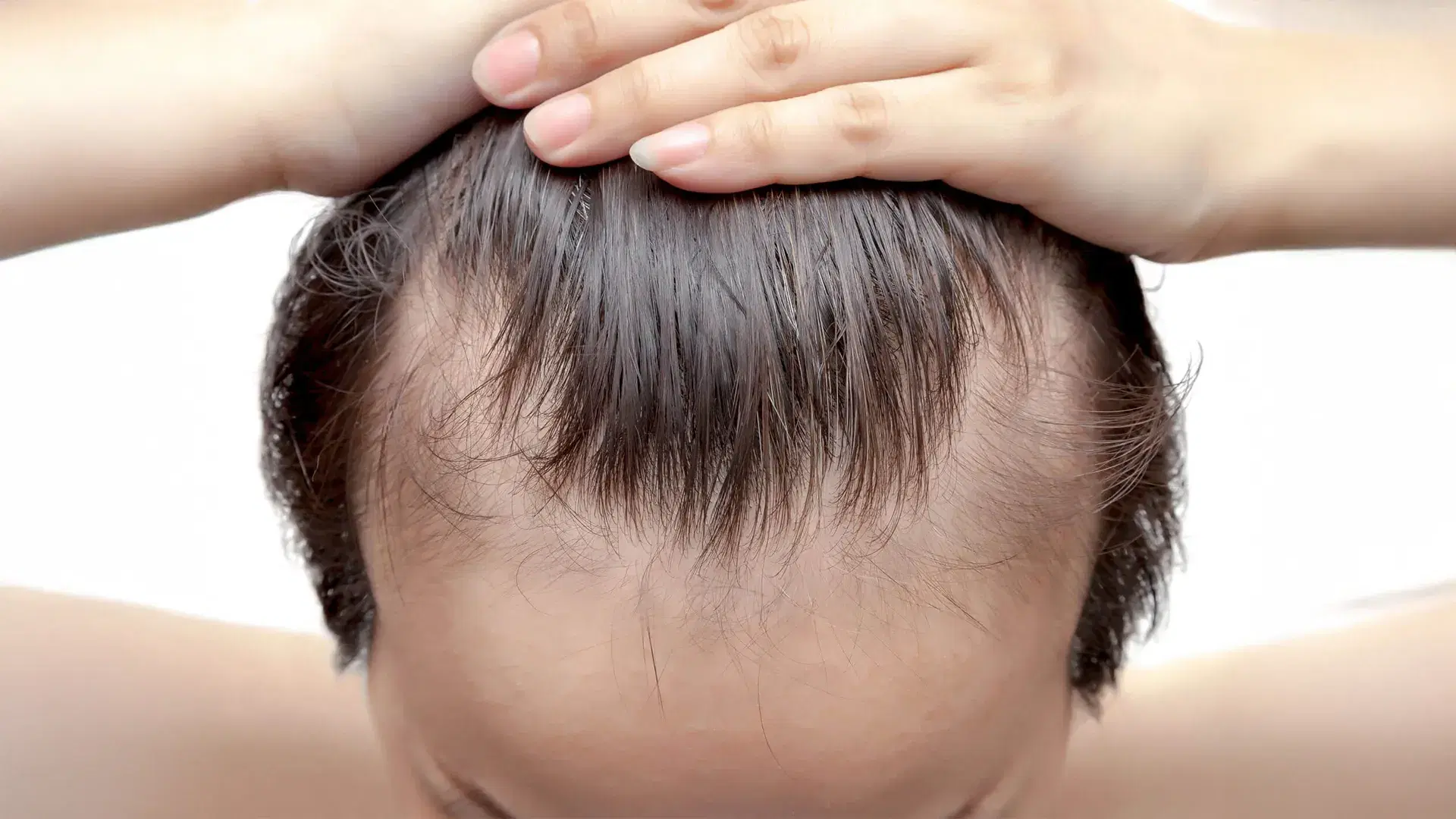 How to Stop a Receding Hairline?