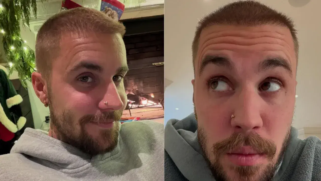 Justin Bieber Hair Transplant: Rumours, Facts and Analysis