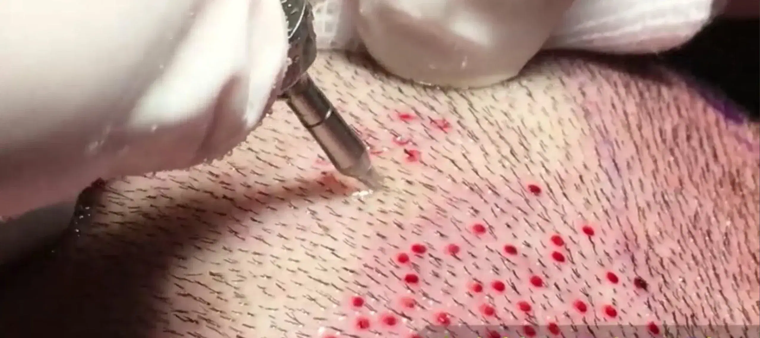 No-Shave FUE Hair Transplant: Process and Benefits
