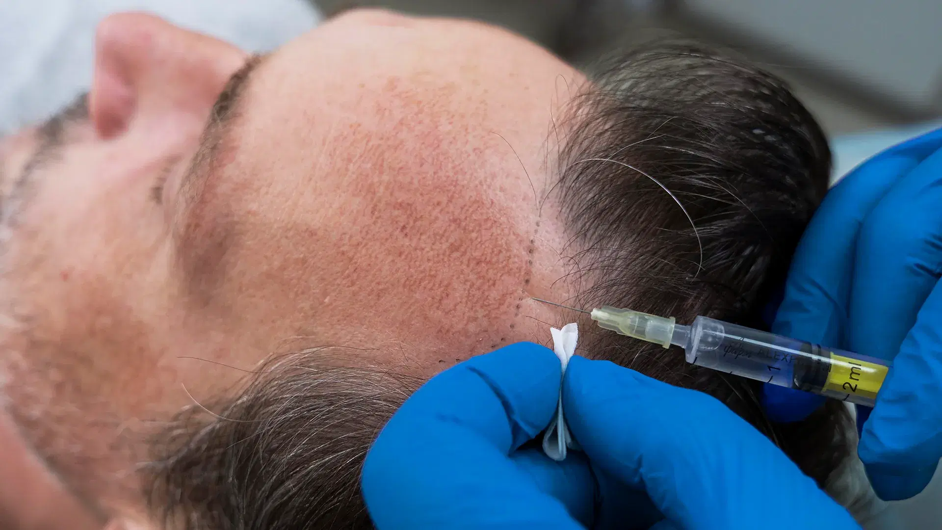Non-Surgical Hair Loss Therapies