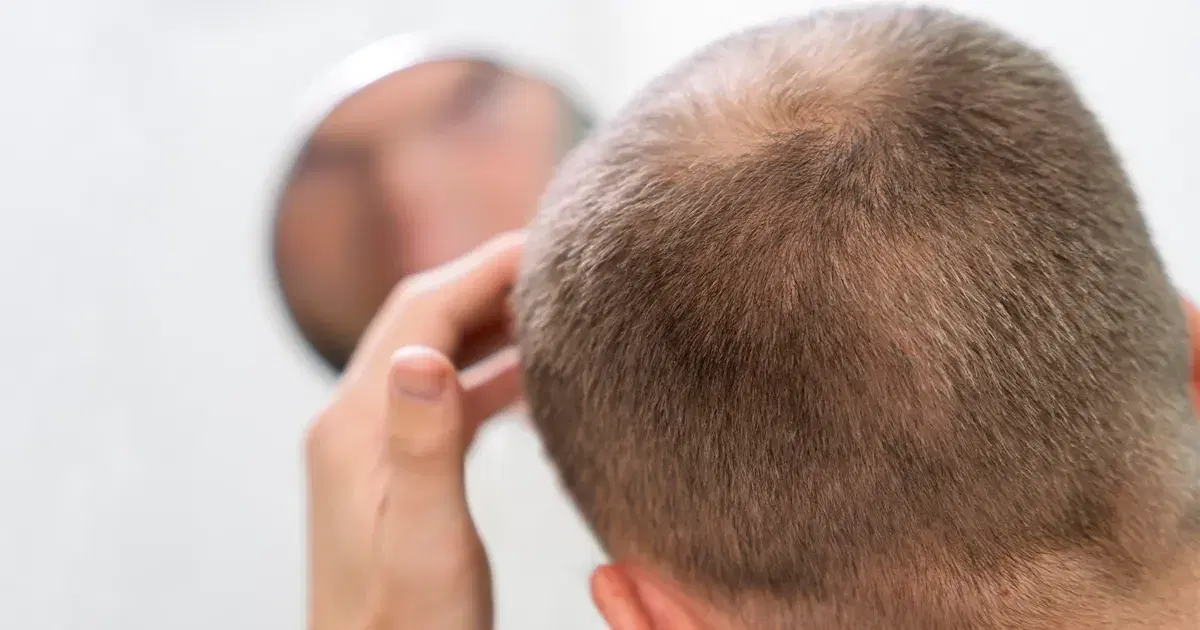 Norwood Scale 1 to 7: How to Know Your Stage of Baldness