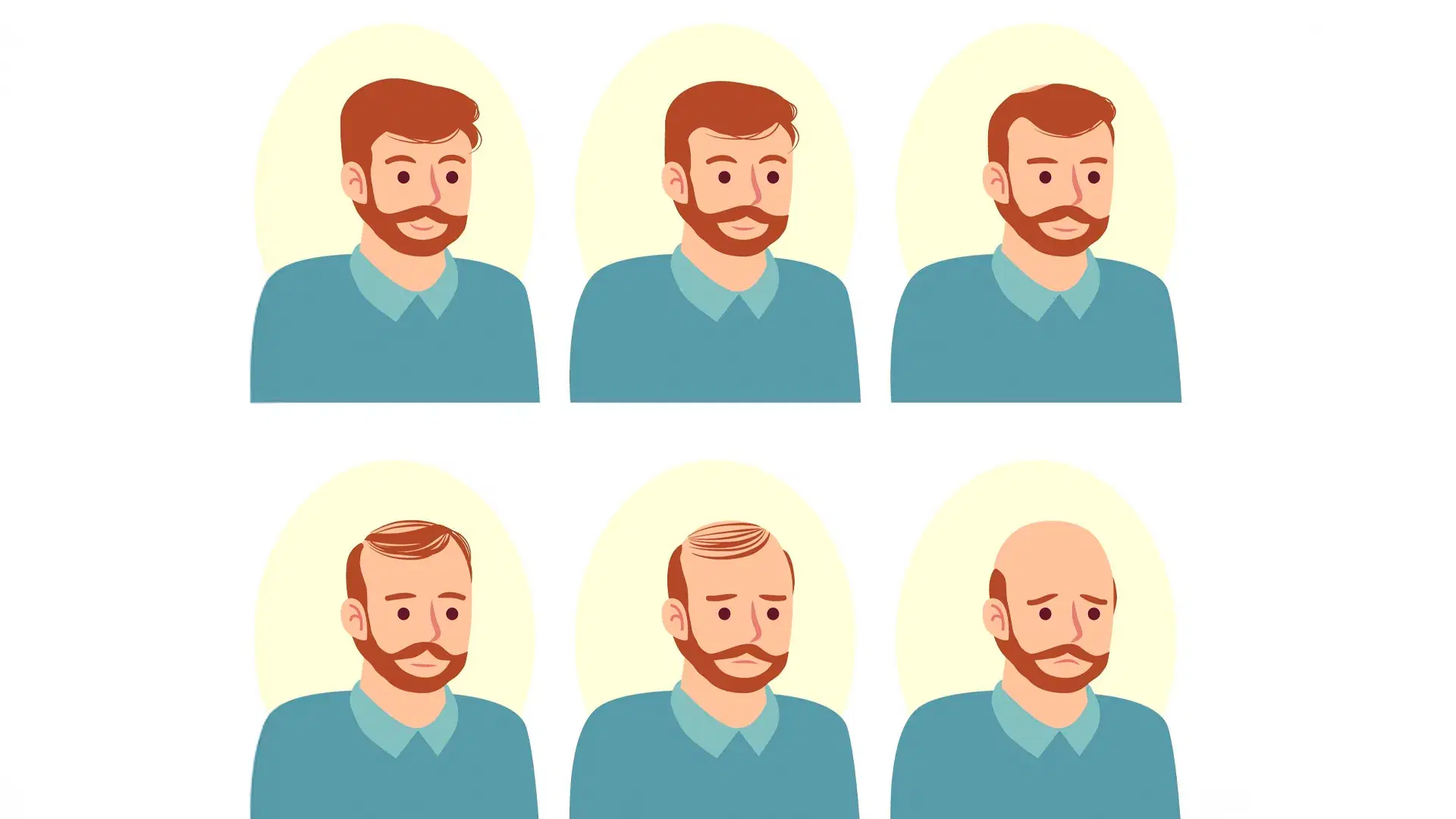 Norwood Scale Stages 1 to 7