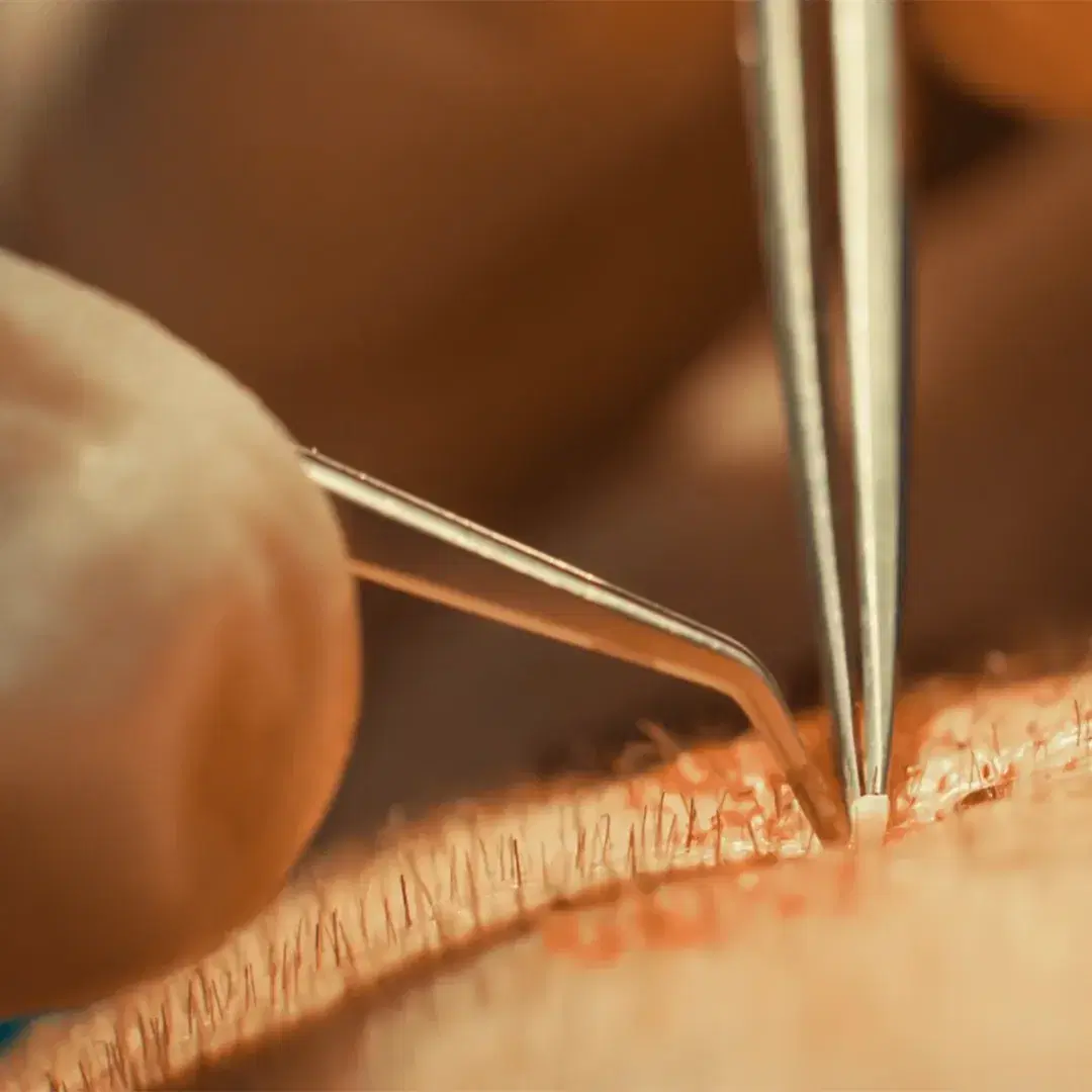 <h3 style="color: rgb(37, 39, 44);"><span style="color: rgb(247, 248, 248);">Follicle extraction</span></h3><h3 style="color: rgb(37, 39, 44);"></h3>