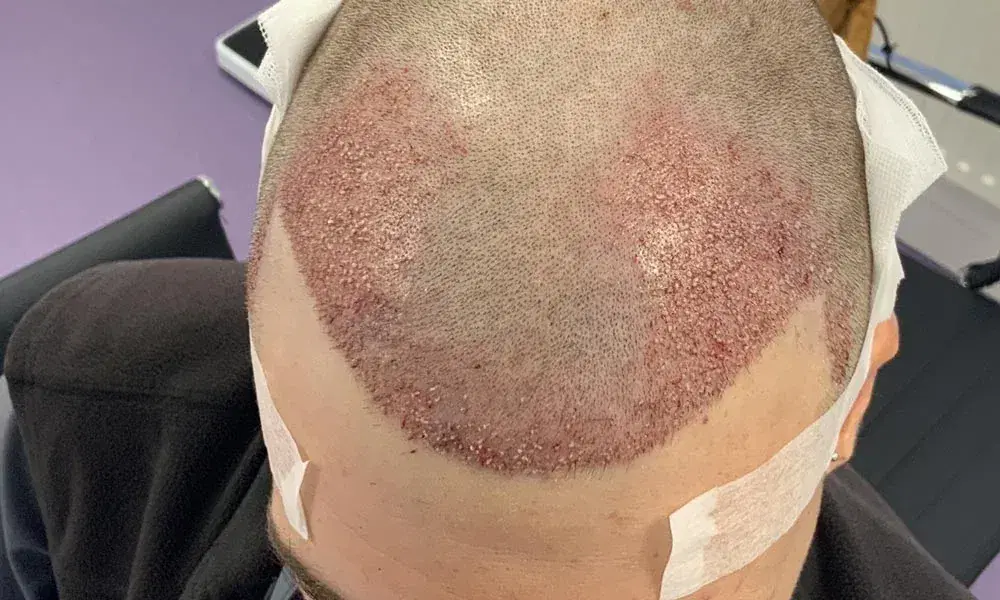 Transgender Hair Transplant: Gender-Affirming Options