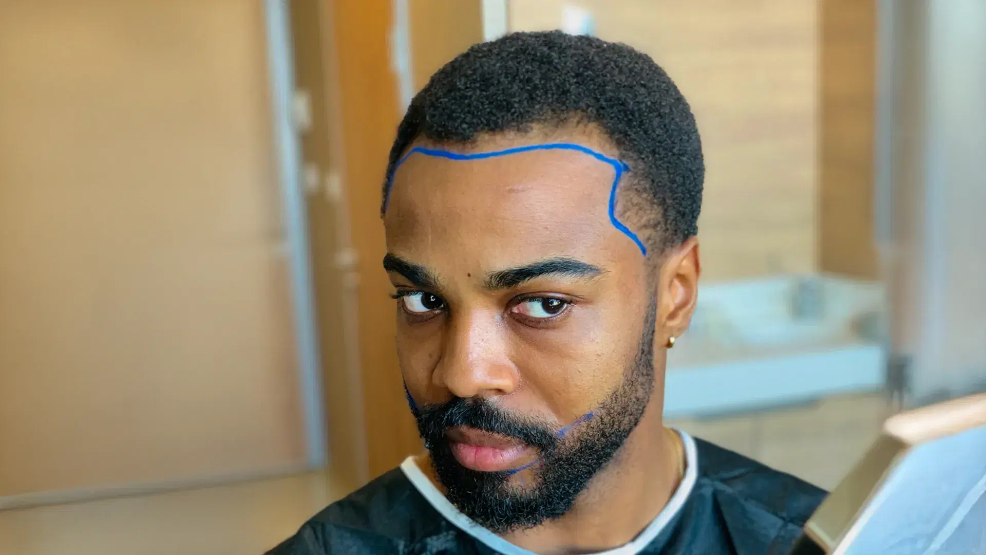 Understanding Afro Hair Transplant