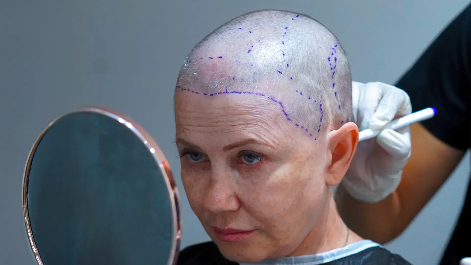 The Causes Of Hair Loss In Women