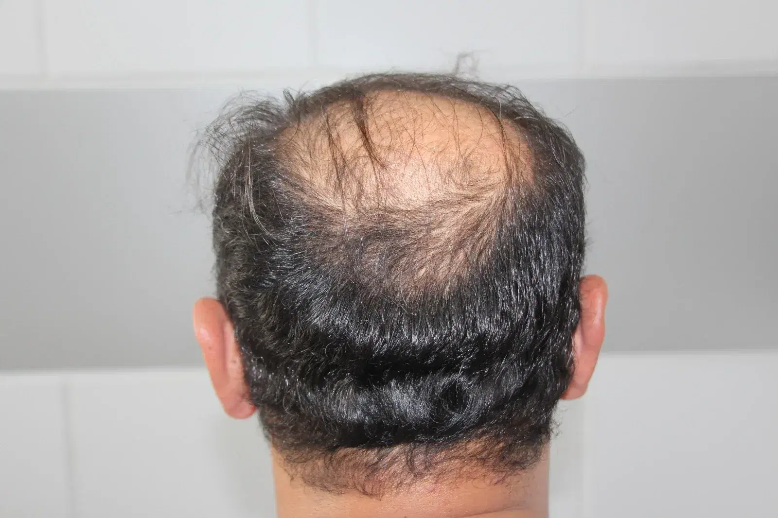 Can You Get a Hair Transplant With a Weak Donor Area?