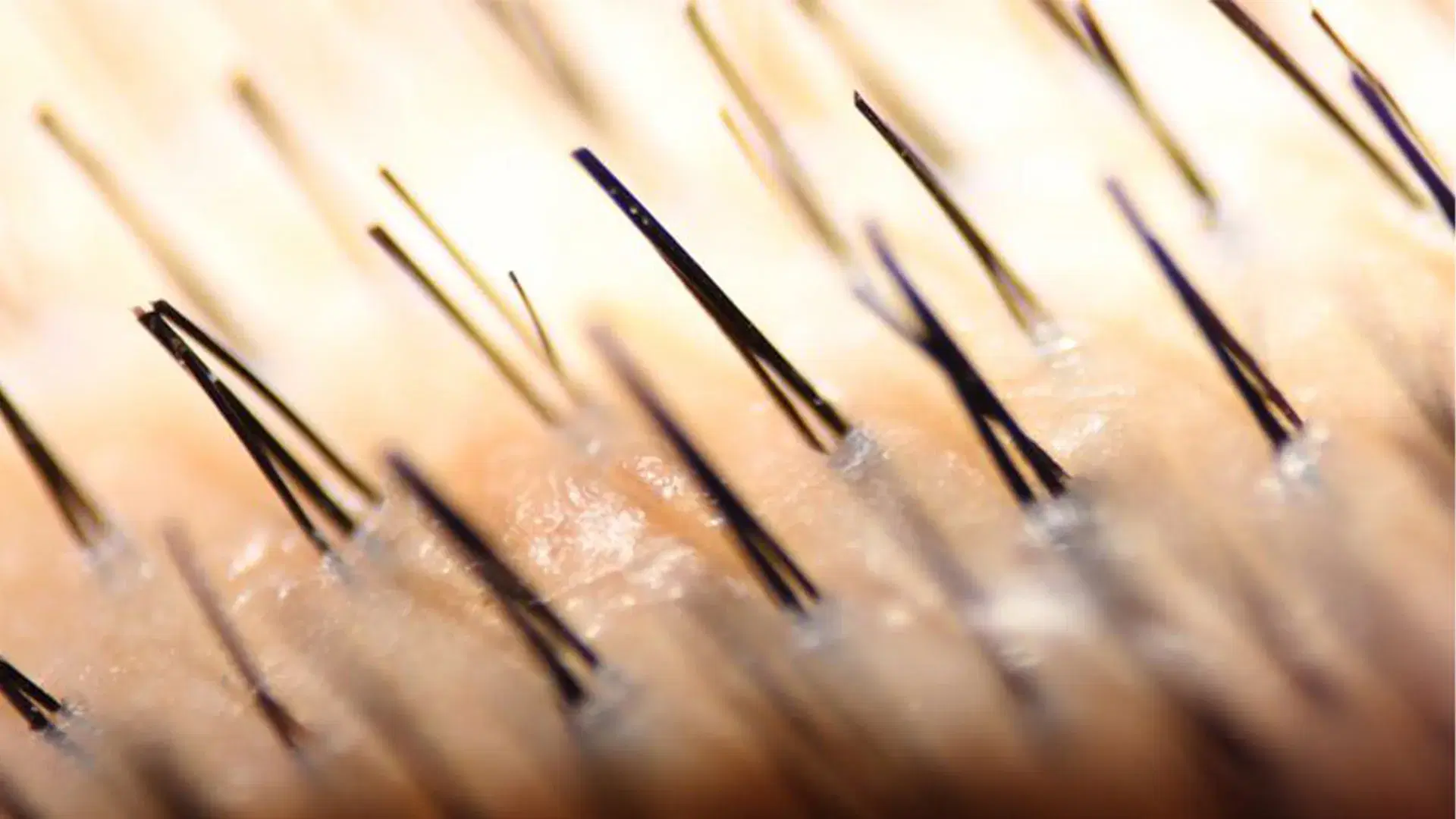 What Is A Body Hair Transplant?