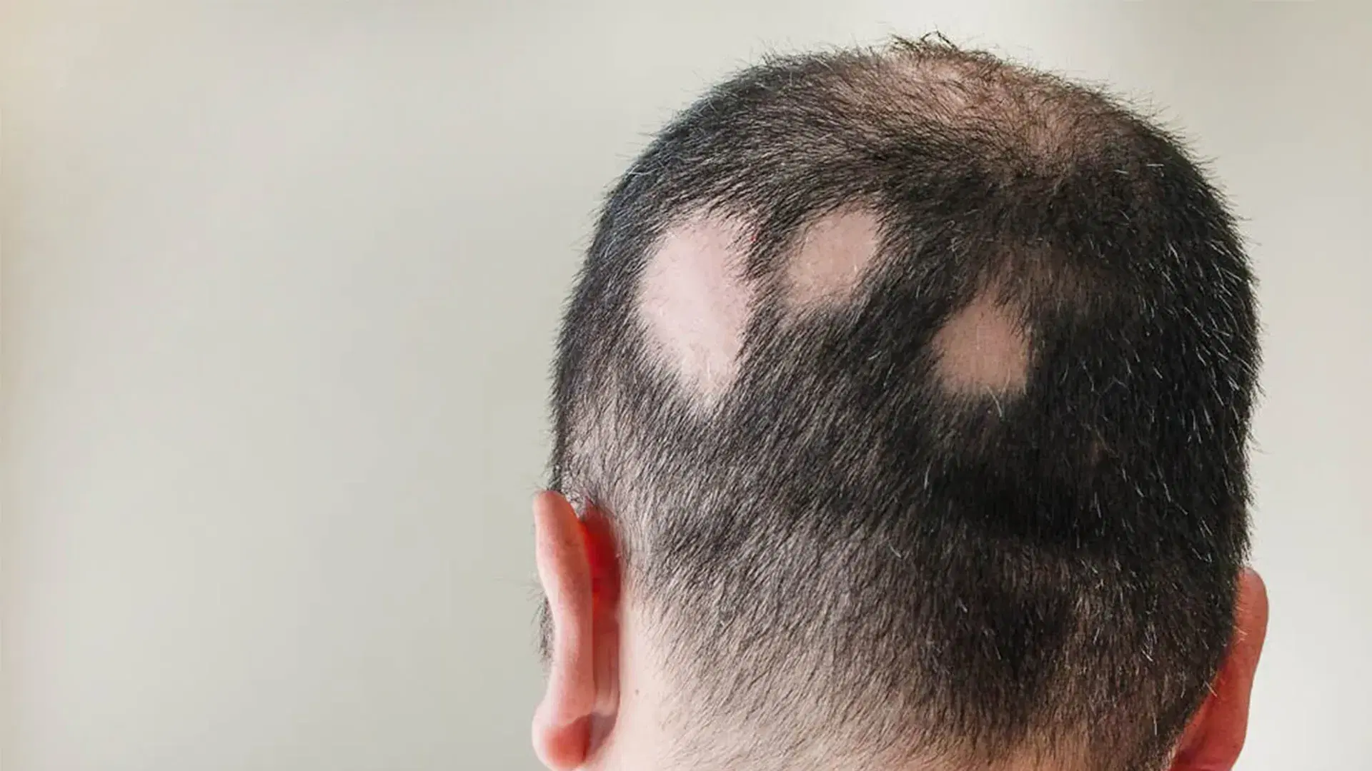 What Is Alopecia Areata?