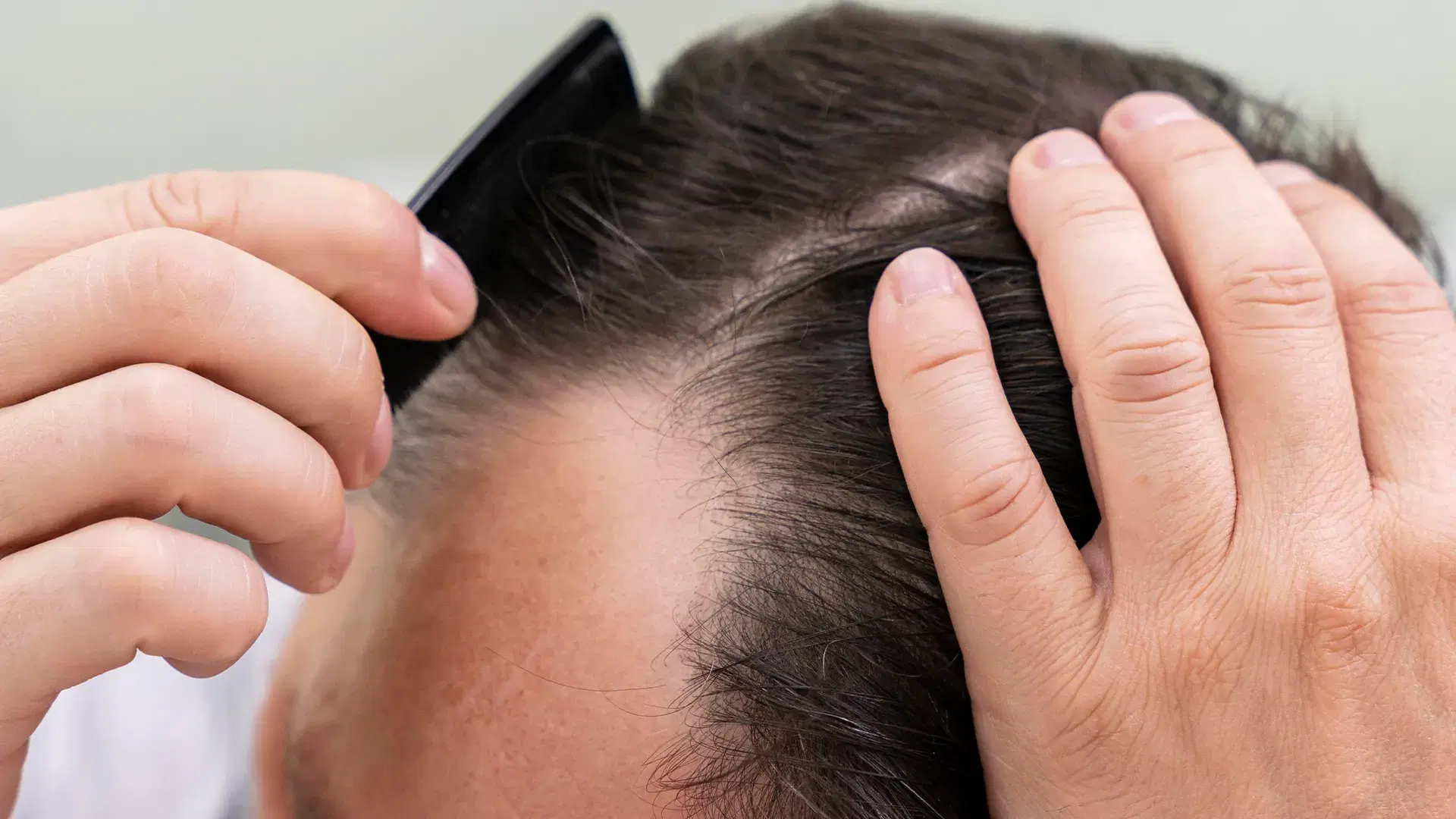 What Is PRP Treatment for Hair?