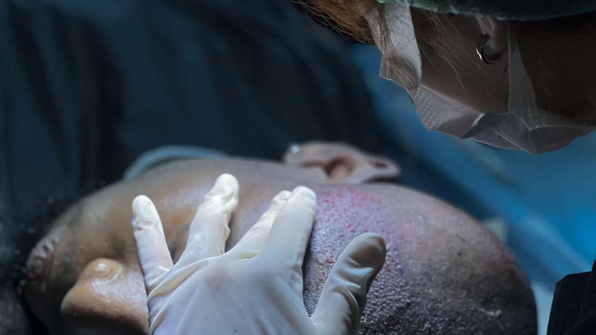 What Is a Hair Transplant?