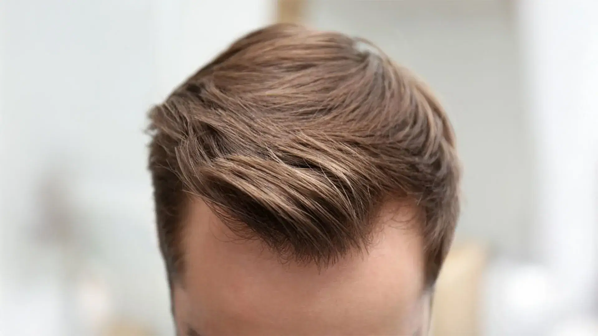 What Is a Receding Hairline?