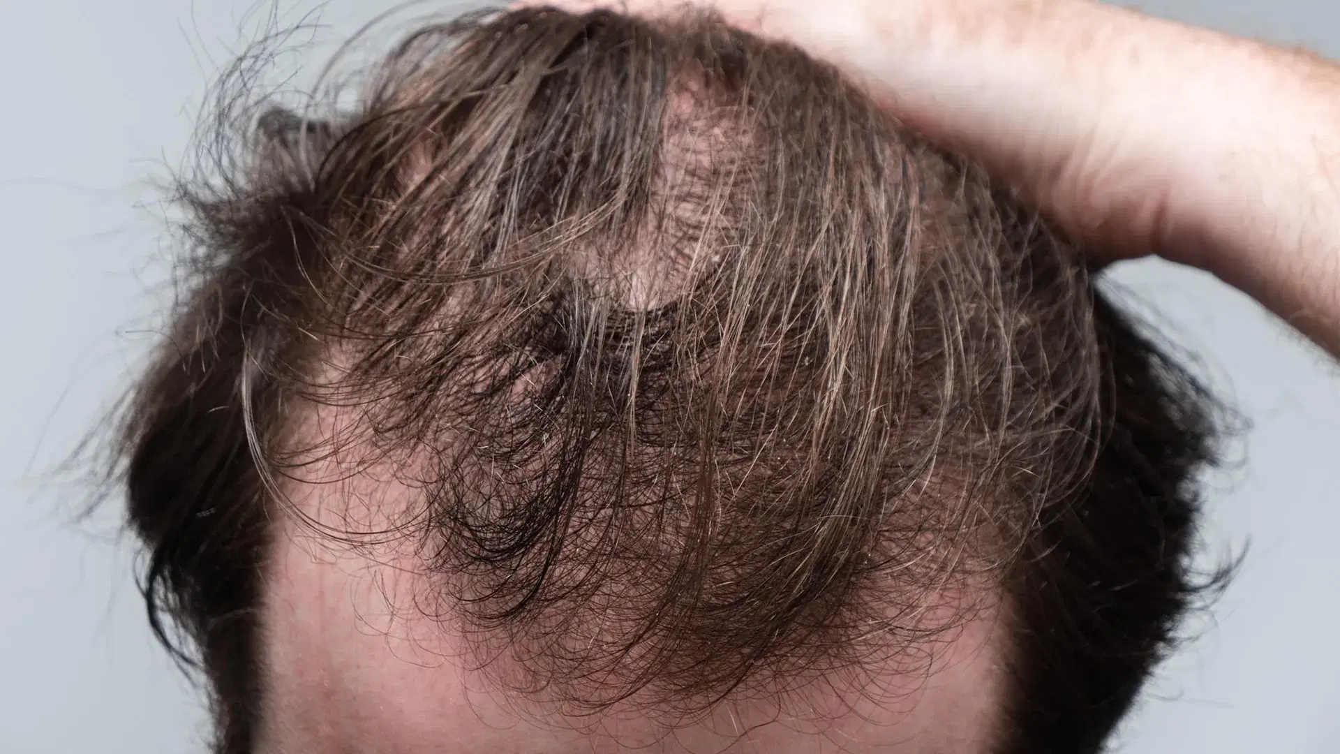 What is Telogen Effluvium?