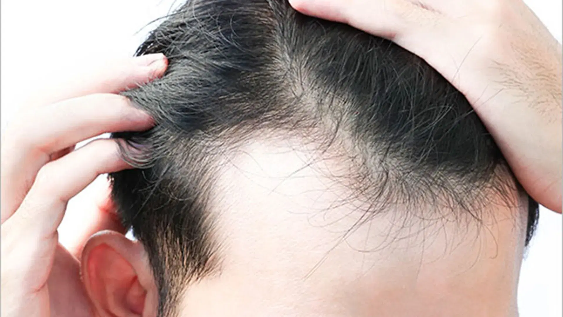 What triggers Telogen Effluvium?