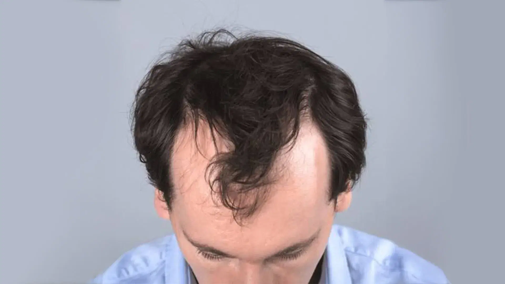 Why Is My Hairline Receding?