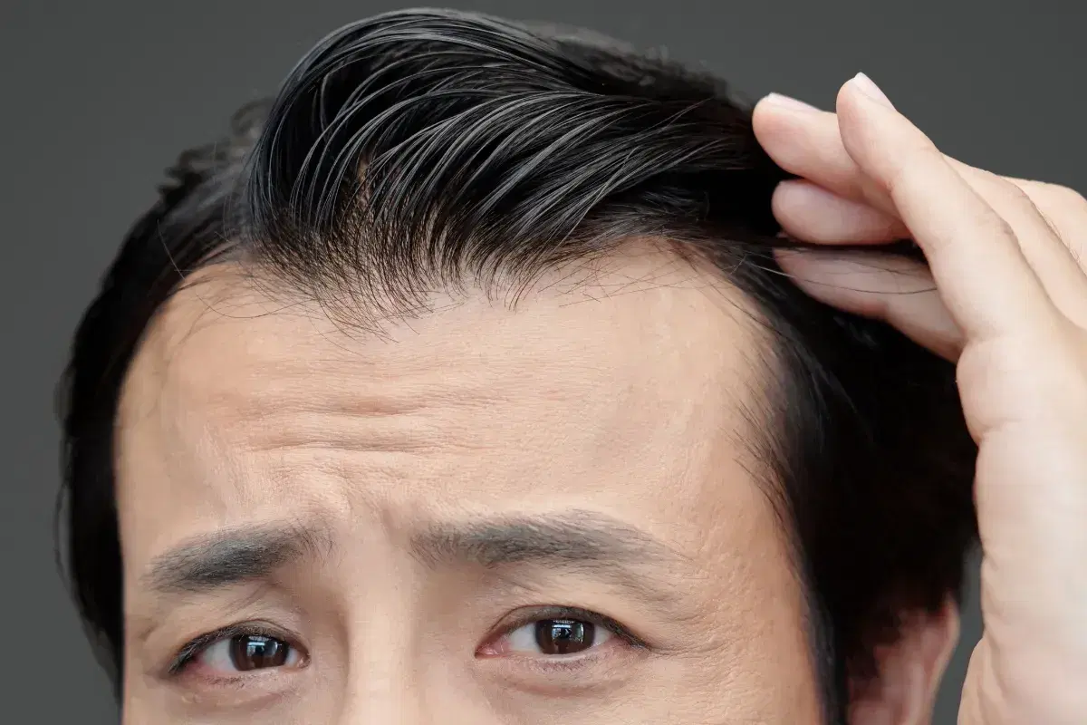 Does Minoxidil Work on Hairline? Evidence & Limits