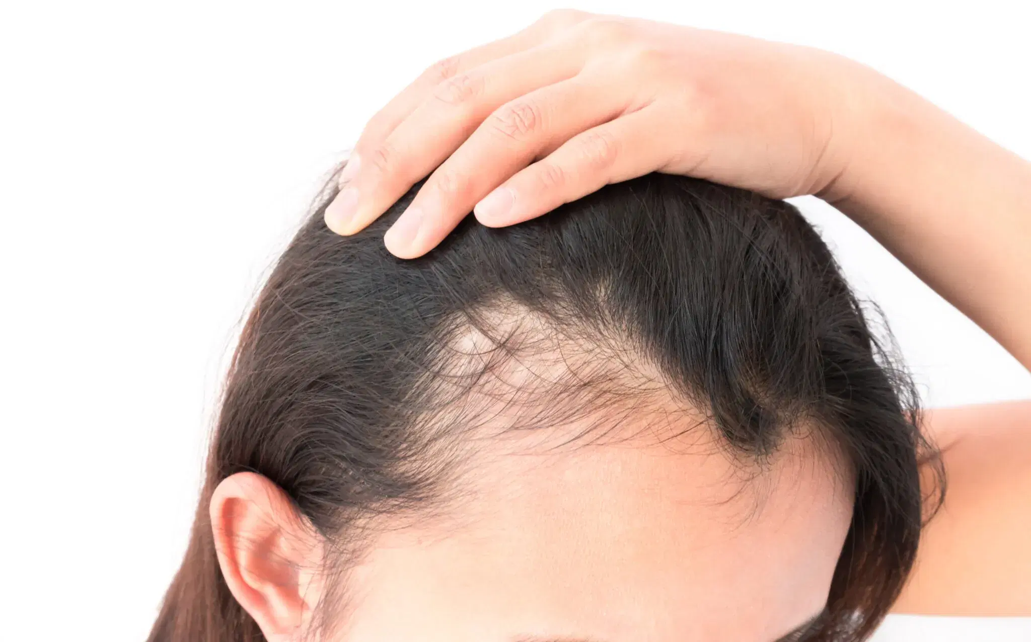 Hair Loss After Stopping Birth Control: Why It Happens and When Hair Grows Back
