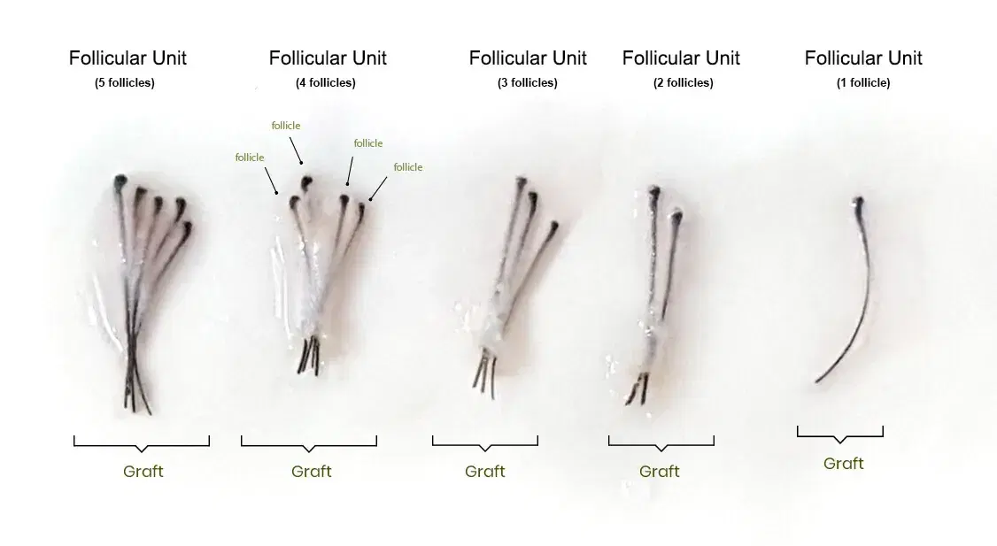 Hair Plugs vs Hair Transplant: What Is the Difference?