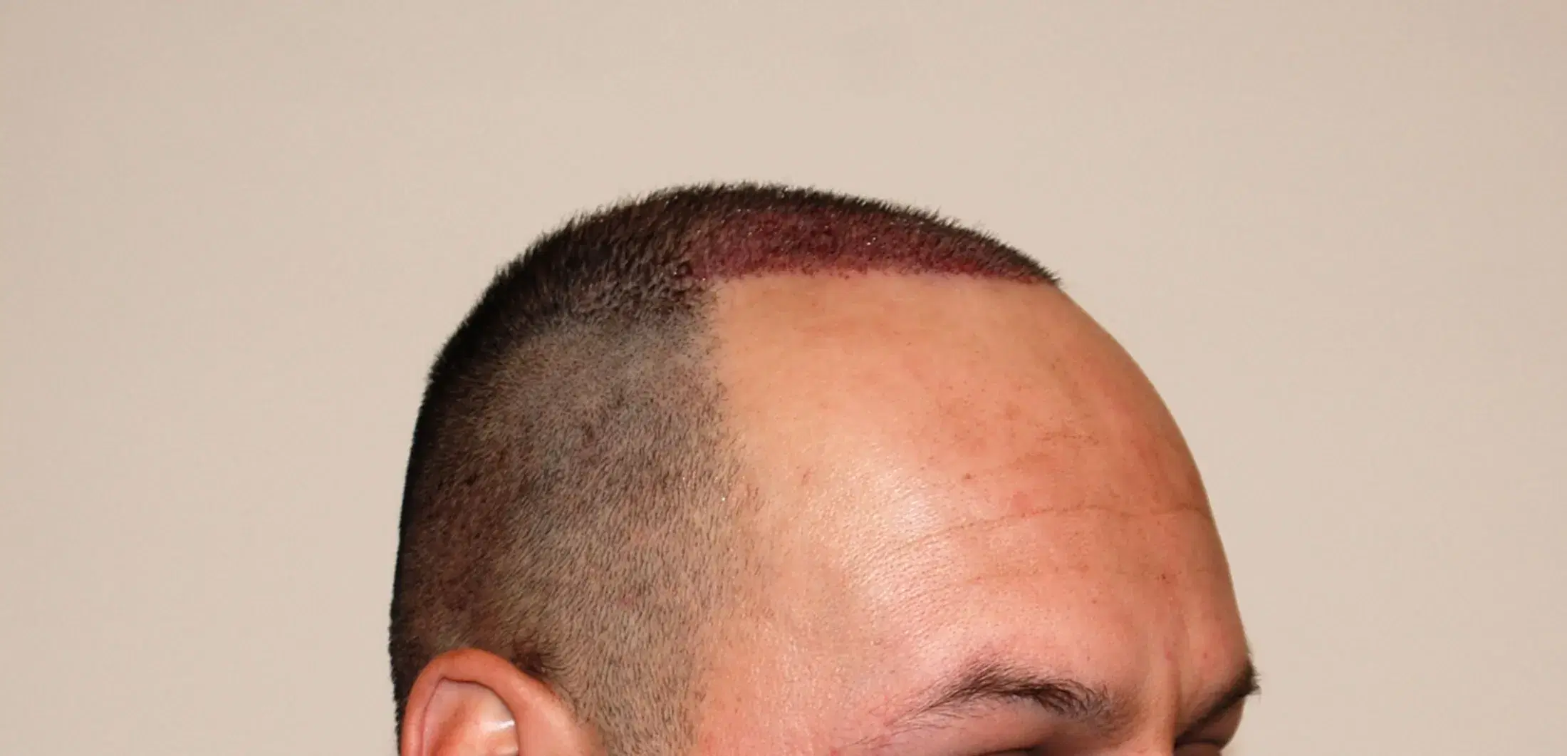 Does Smoking Affect Hair Transplant Results?