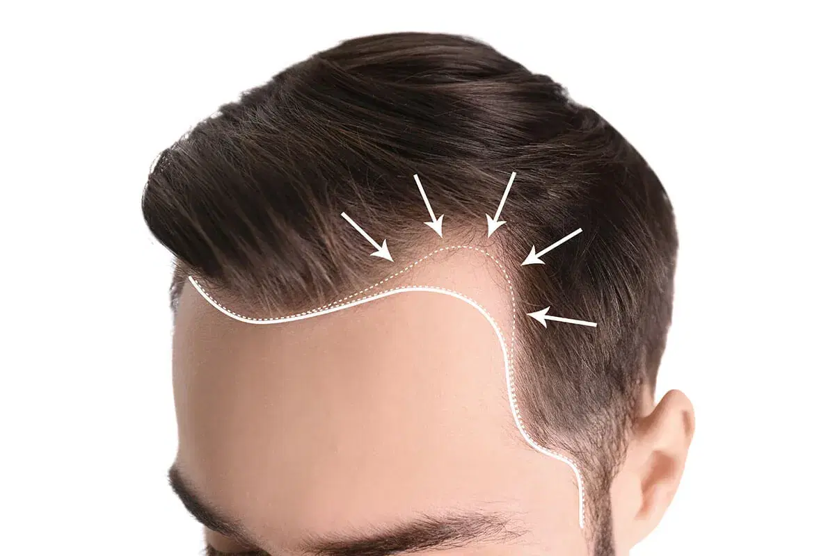 Why Is My Hairline Receding Faster on One Side?