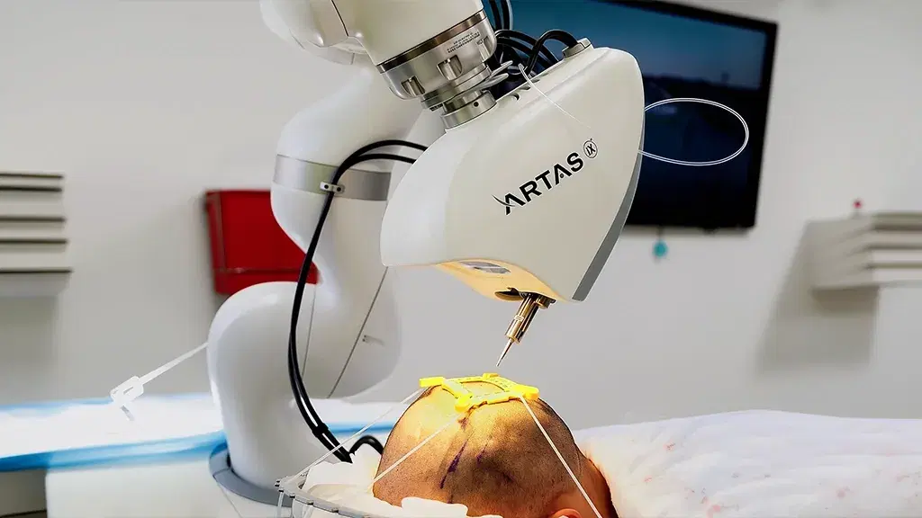 What Is a Robotic Hair Transplant?