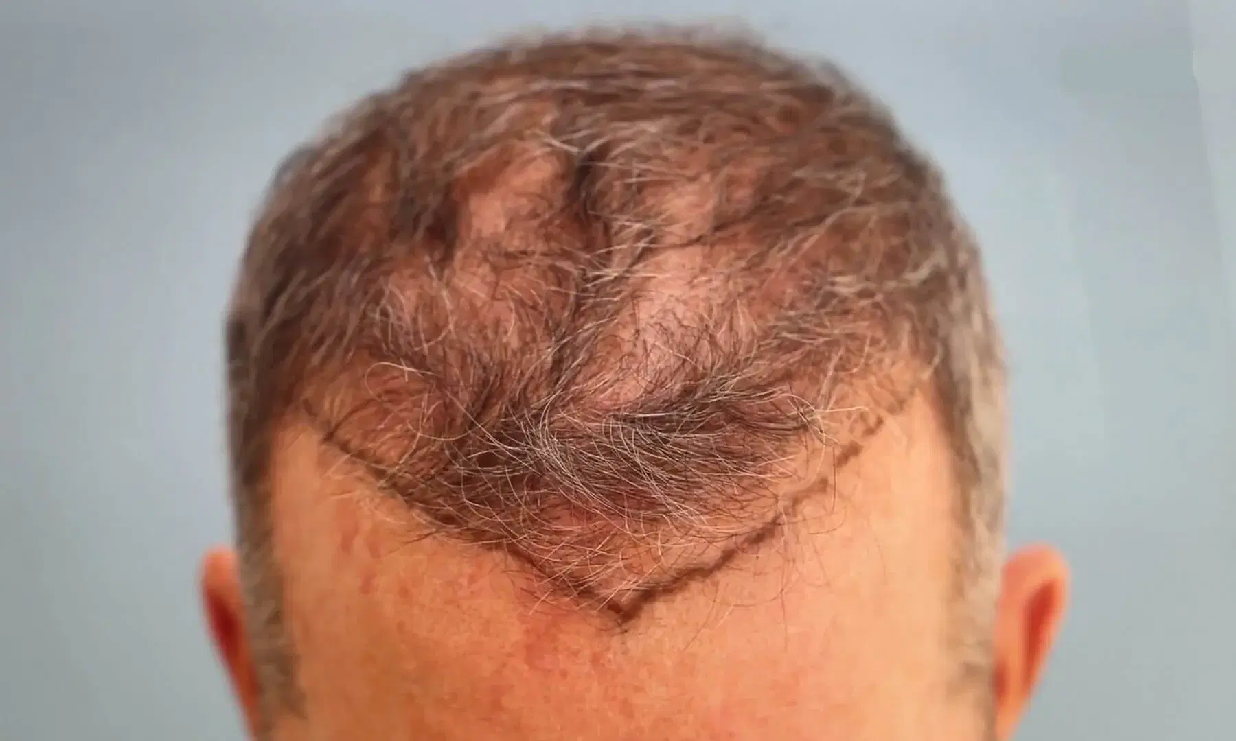 When Can You Have a Second Hair Transplant?