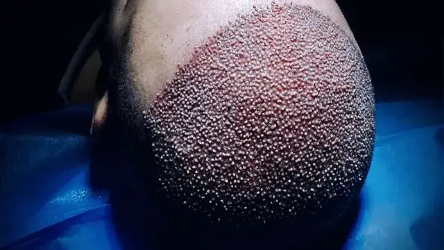 DHI Hair Transplant