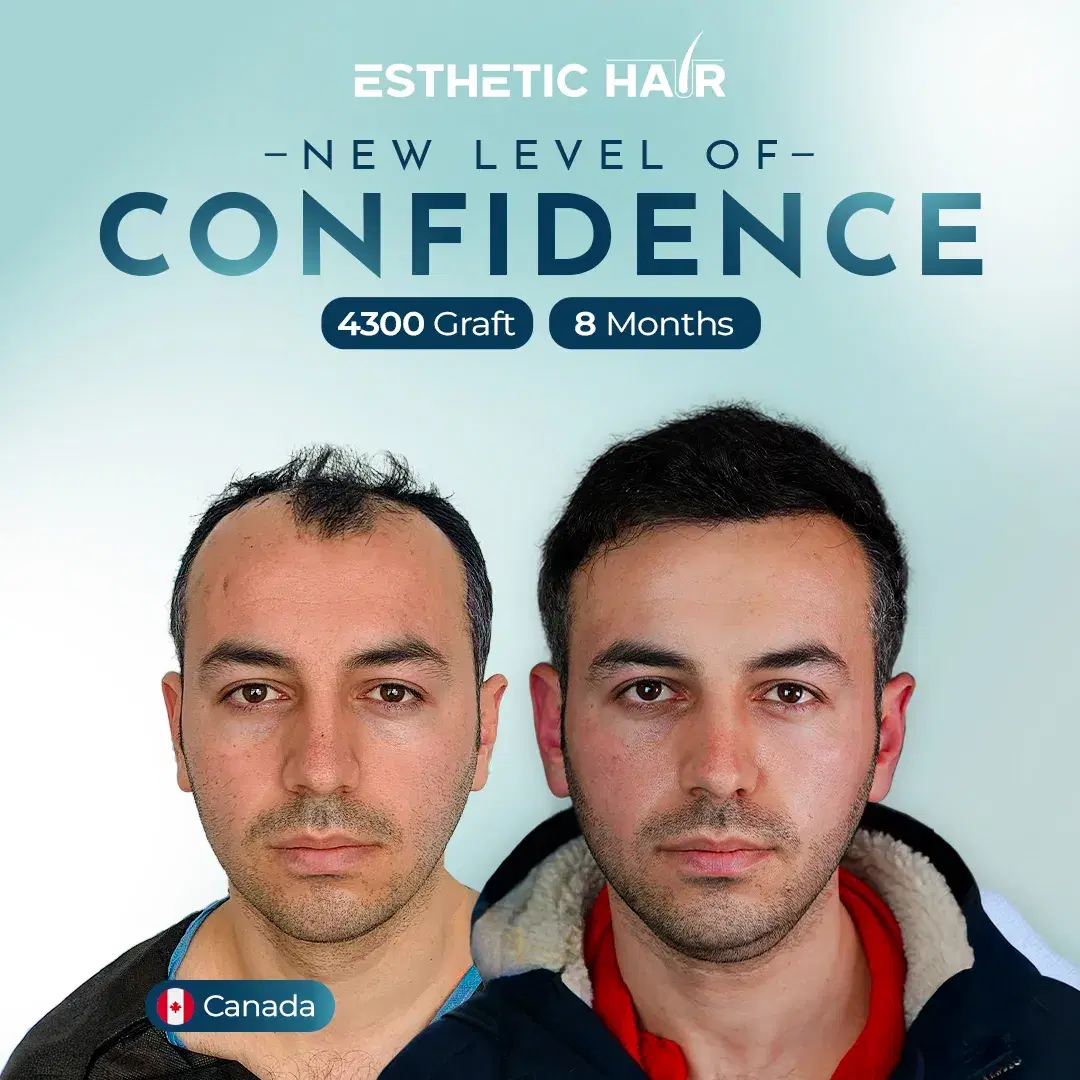 4300 Grafts - Canada