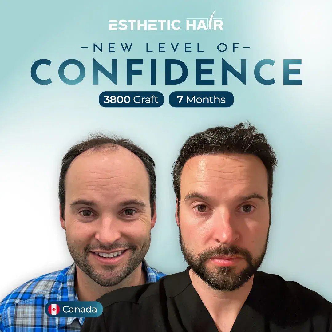 3800 Grafts - Canada
