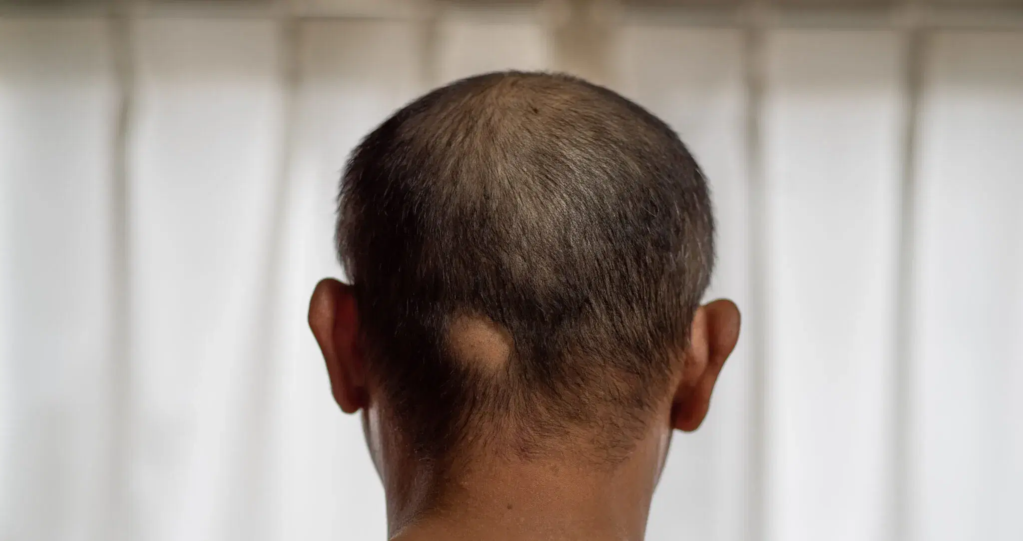Can Tight Hairstyles Cause Alopecia?