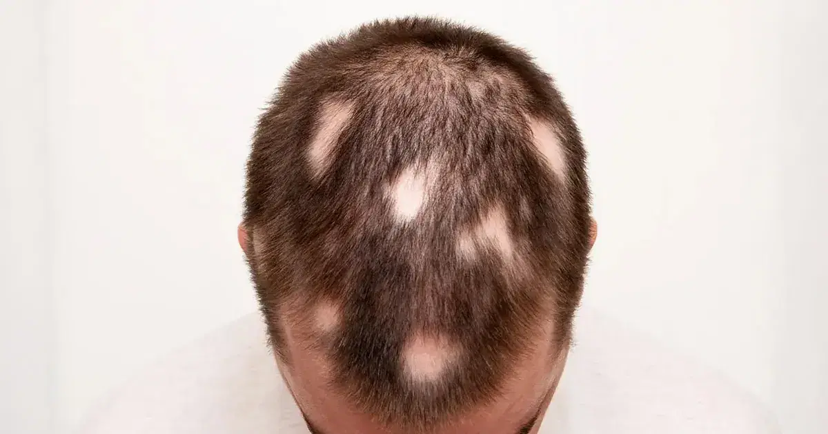 Alopecia Areata: Causes, Symptoms, and Treatments Explained