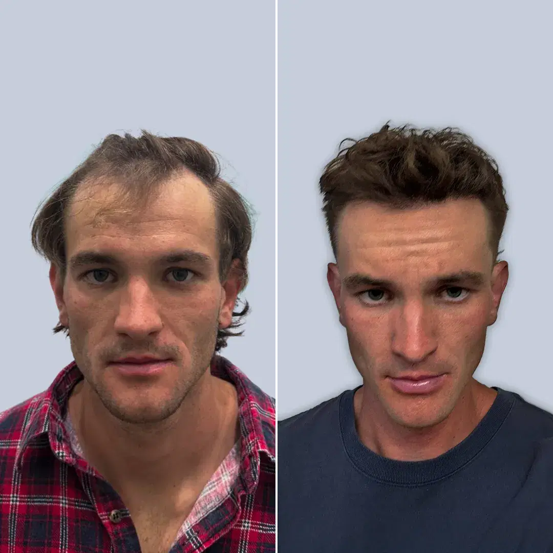 Hair Transplant Before and After Results