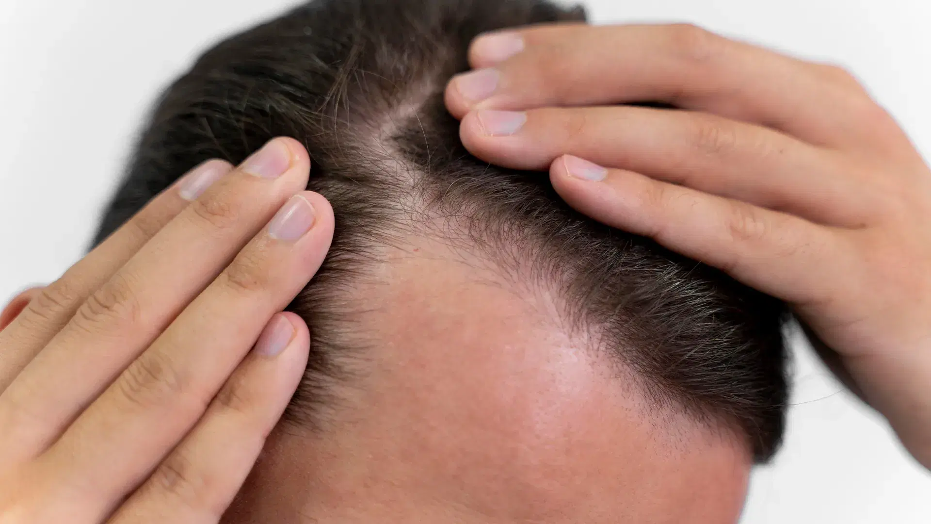 Can a Maturing Hairline Turn Into Receding Hair Loss?