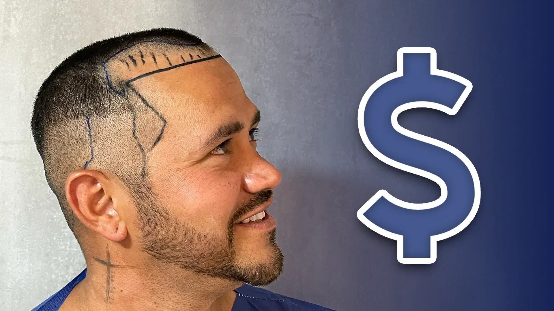 Cost of No Shave Hair Transplant with DHI