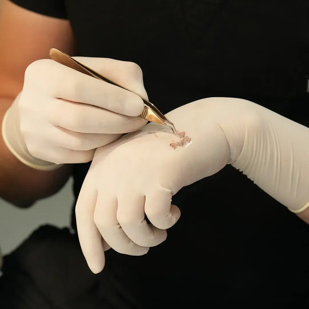 <h3><span style="color: rgb(247, 248, 248);">2. Graft Preparation and Loading</span></h3><p></p>