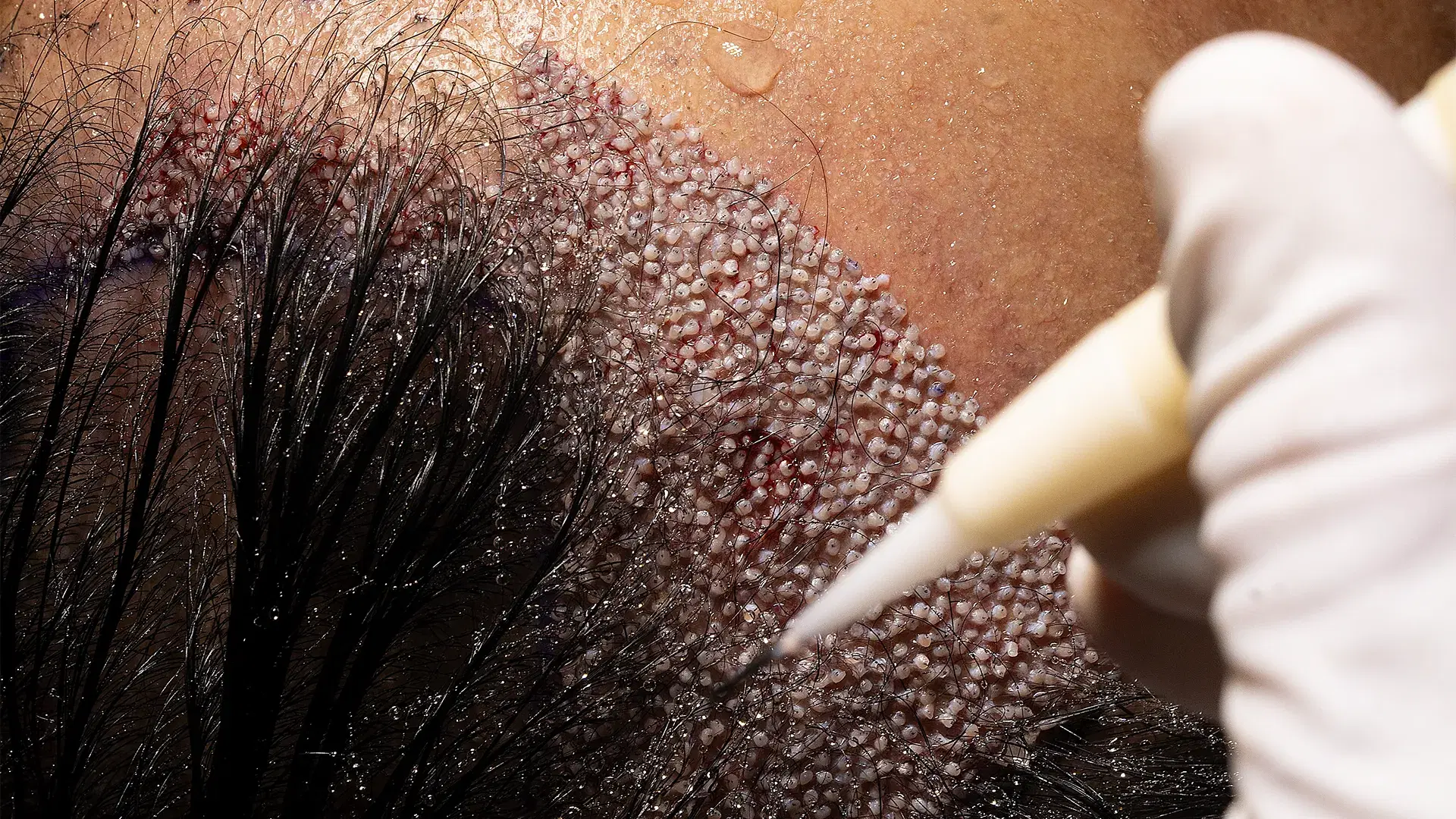 <h3><span style="color: rgb(247, 248, 248);">3. Direct Implantation Between Existing Hair</span></h3><p></p>