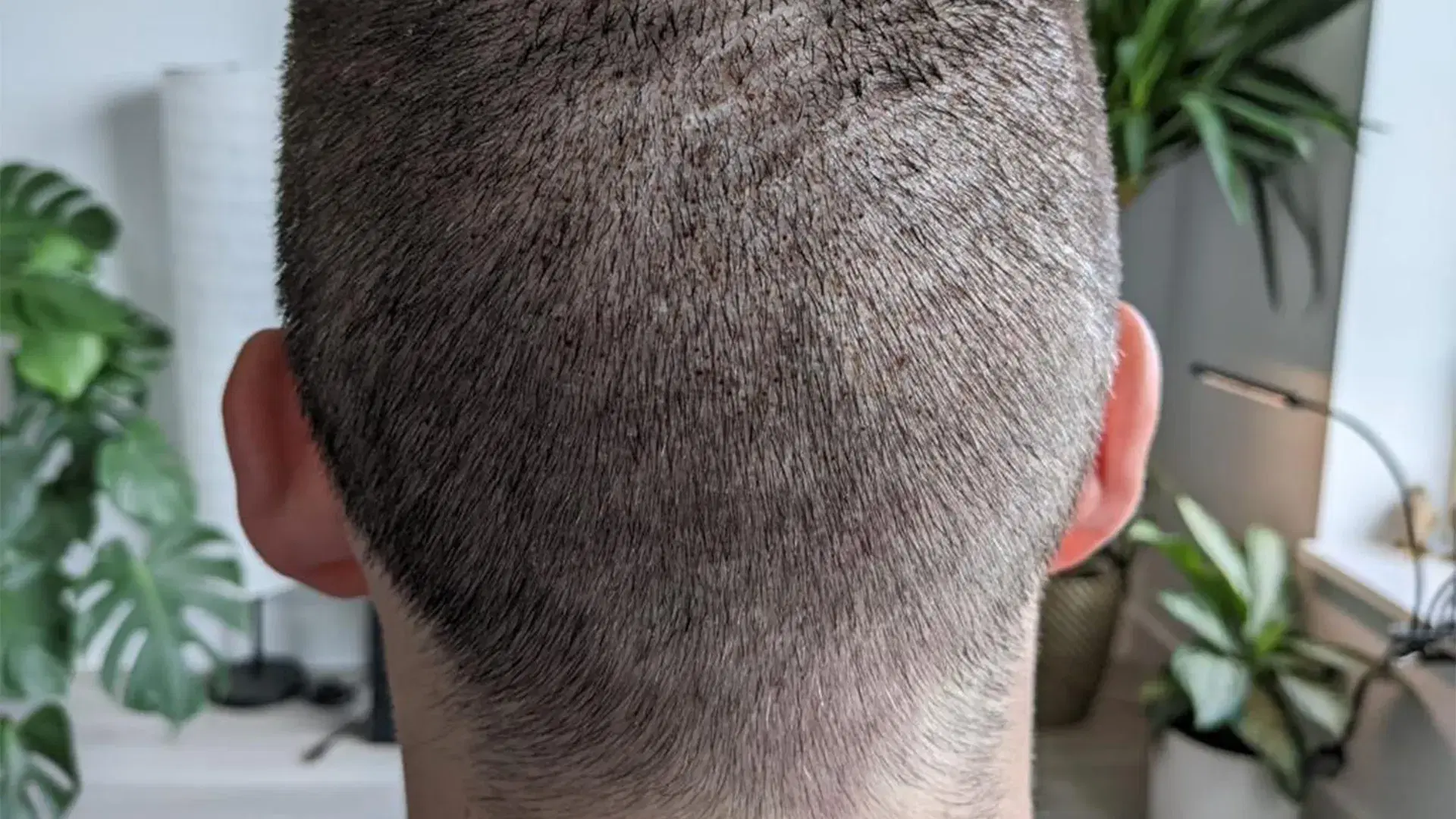 Donor Area After a Hair Transplant