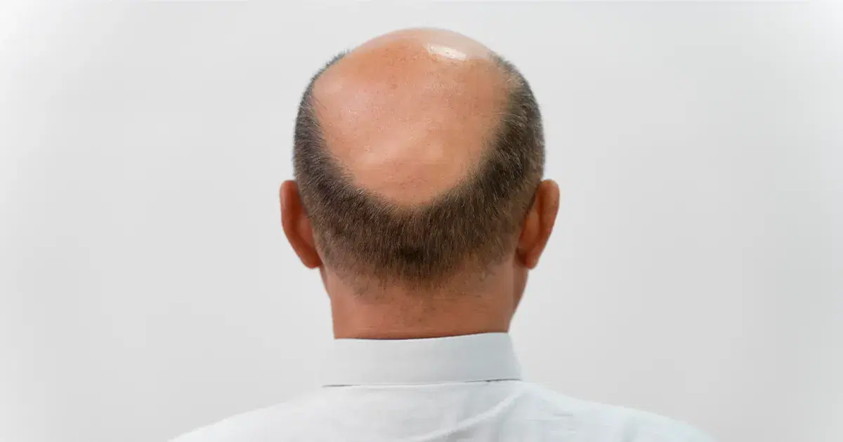 Donor Area: All You Need to Know Before a Hair Transplant